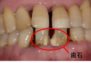 口腔内の病気による病的口臭