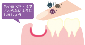 抜歯した場所には触れないように
