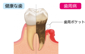 健康な歯と歯周病の比較