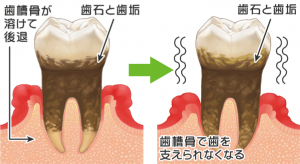 骨が溶ける病気