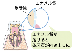 エナメル質が溶けていく過程