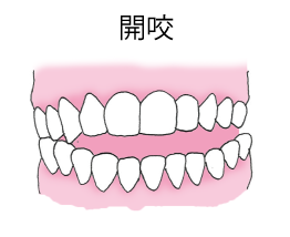 開咬