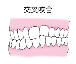 交叉咬合