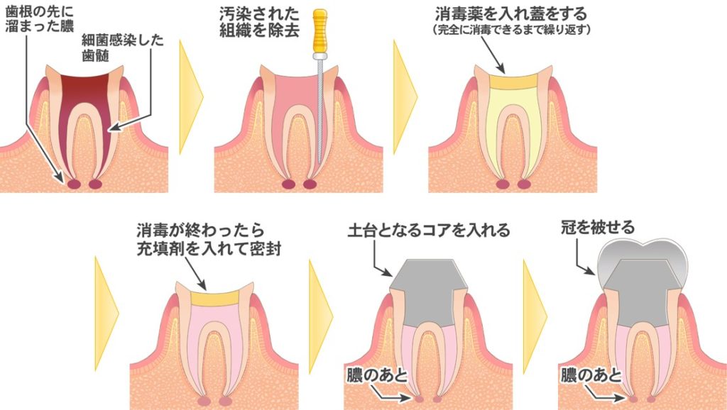 セラミック(陶器)で作られるものなどいくつか種類があり、保険が適応できるかぶせ物と保険が適応できないかぶせ物