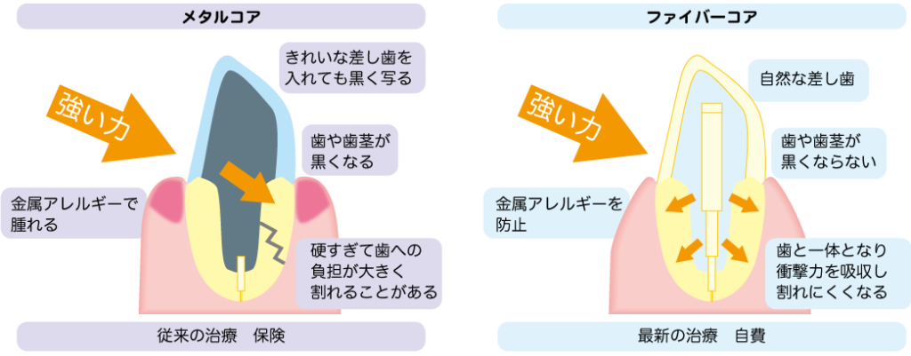 ファイバーコアとメタルコアの違い