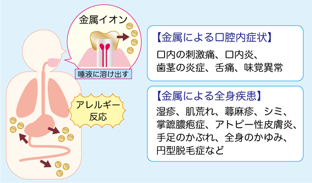 金属アレルギー
