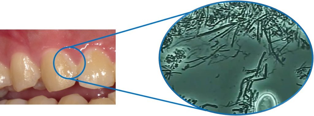 歯垢(プラーク)は何億もの細菌の塊！放置すると歯石になりやがて虫歯の原因となります