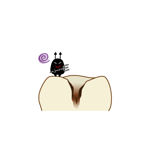 乳歯の虫歯